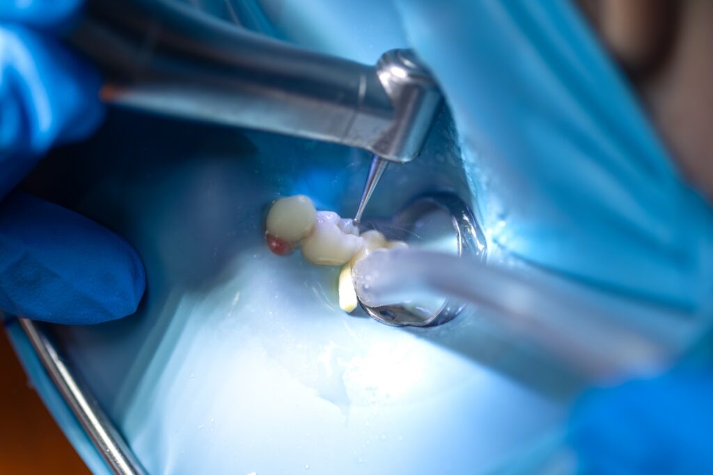 Root Canal in Thousand Oaks