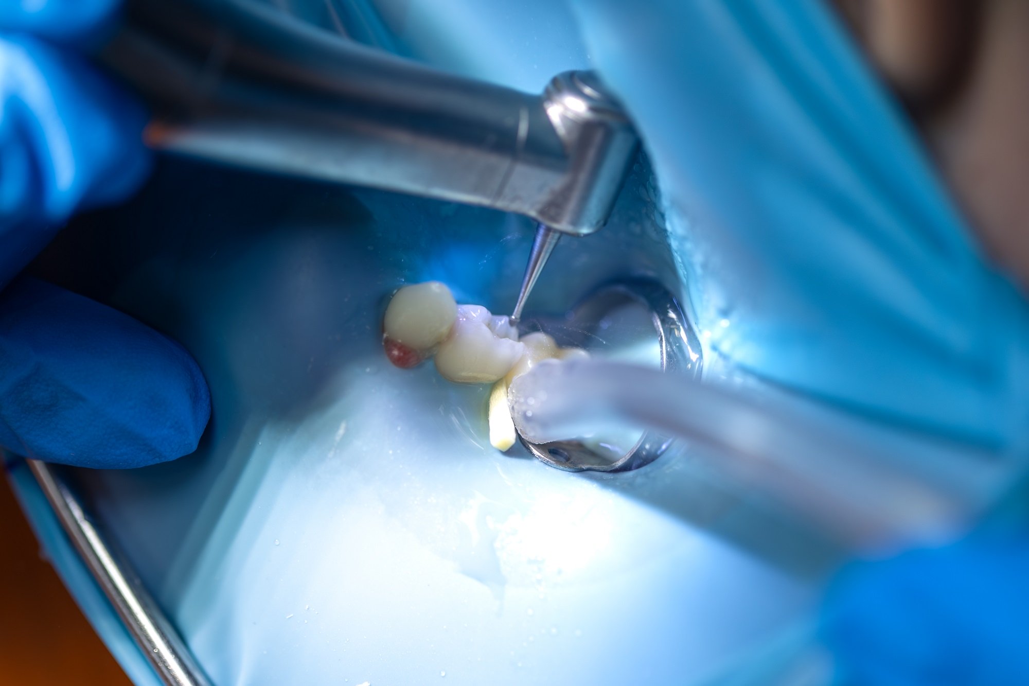 Root Canal in Thousand Oaks