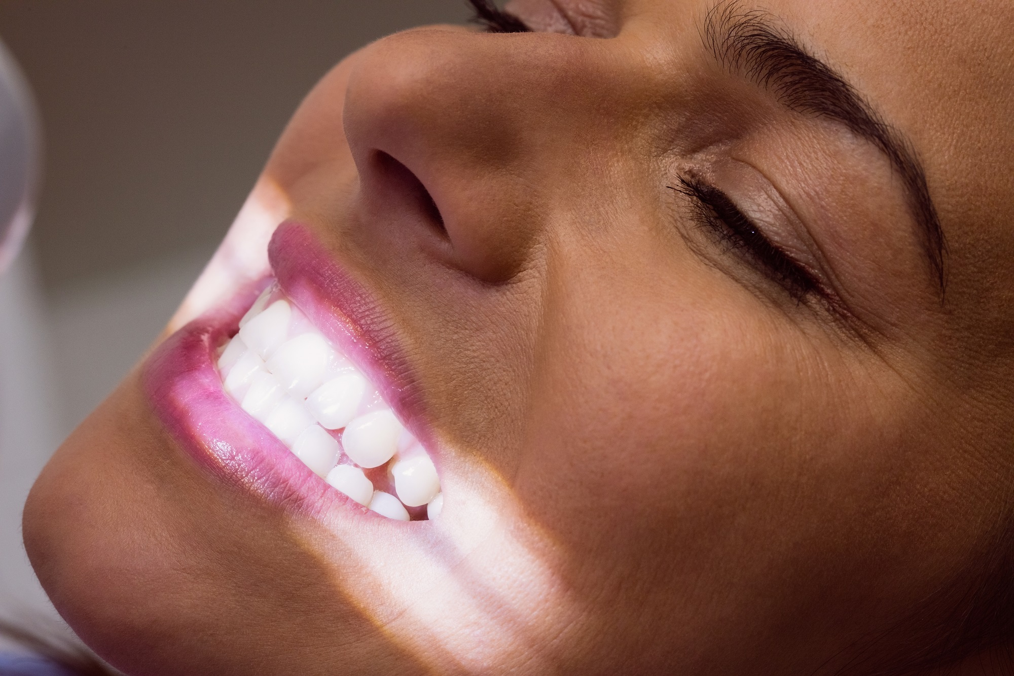 teeth whitening in Thousand Oaks